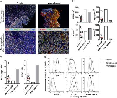 Spontaneous Regression of Ovarian Carcinoma After Septic Peritonitis; A Unique Case Report